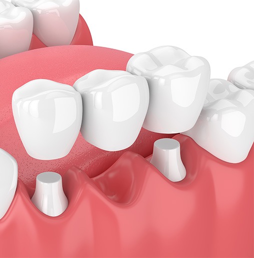 3D image of a dental bridge over abutment teeth with white background