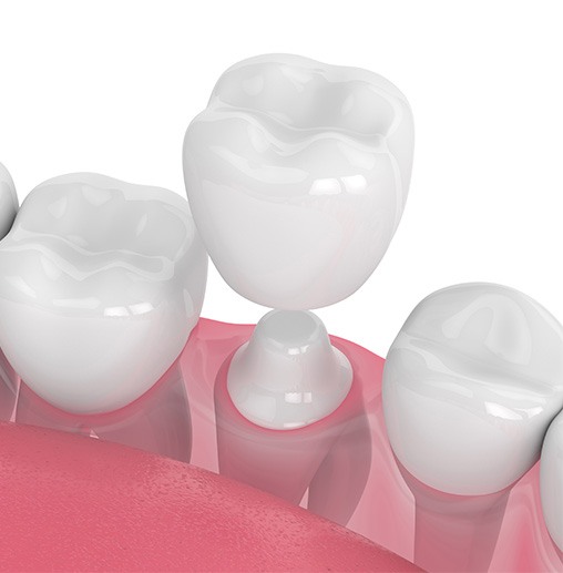 3D image of a dental crown levitating over worn-down tooth with white background