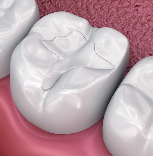 A 3D illustration of tooth-colored fillings