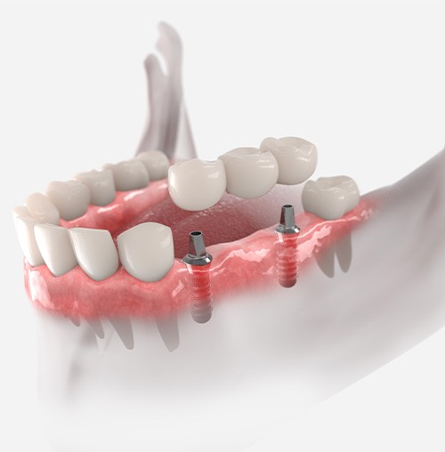 Illustration showing how dental bridge attaches to implants in a lower jaw with white background