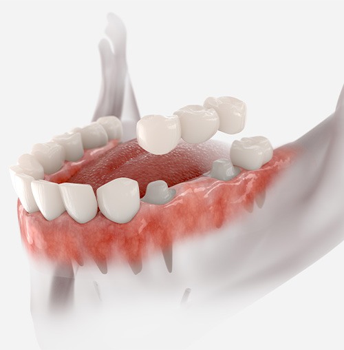 Illustration showing how dental bridges fit over teeth in a lower jaw with white background