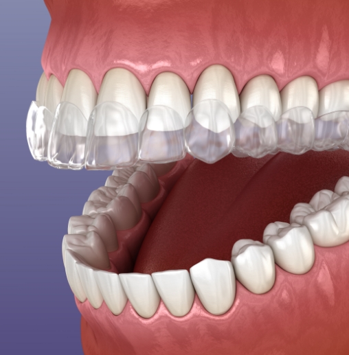 Illustrated Invisalign aligner being placed over upper row of teeth