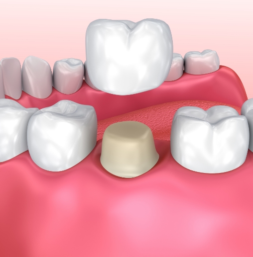 Illustrated dental crown being fitted over a tooth