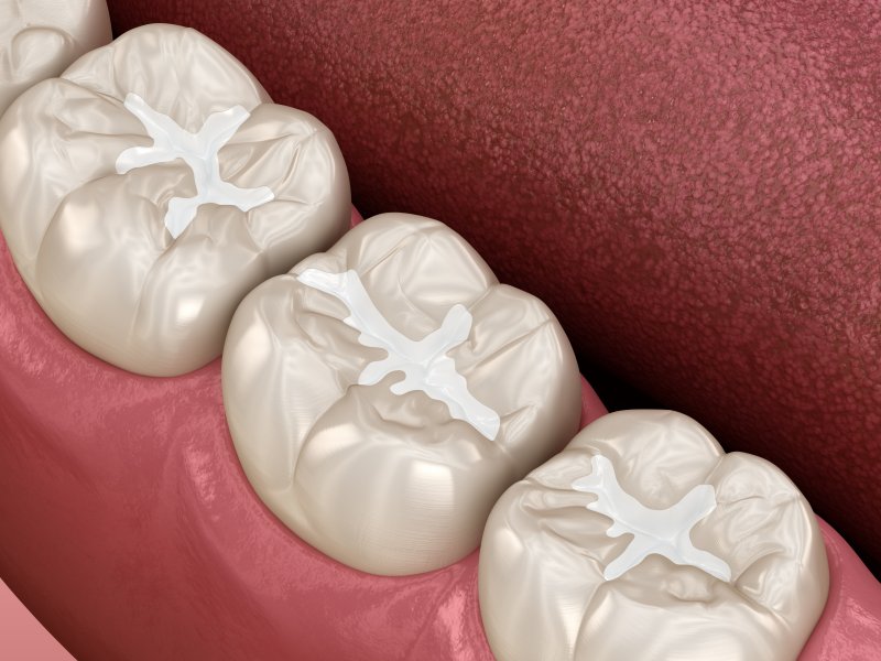 A 3D illustration of teeth with dental fillings